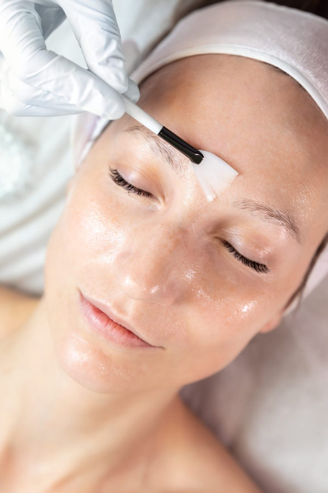 Chemical Peel