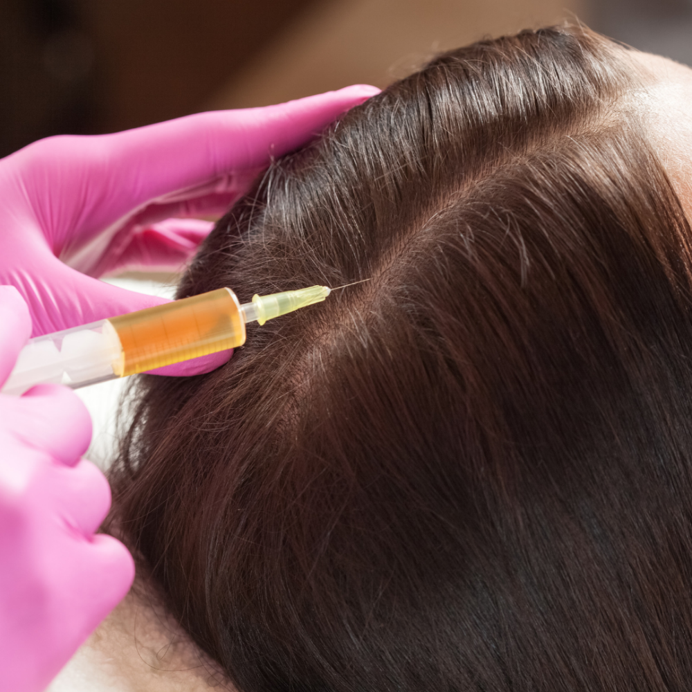 PRP Hair Restoration