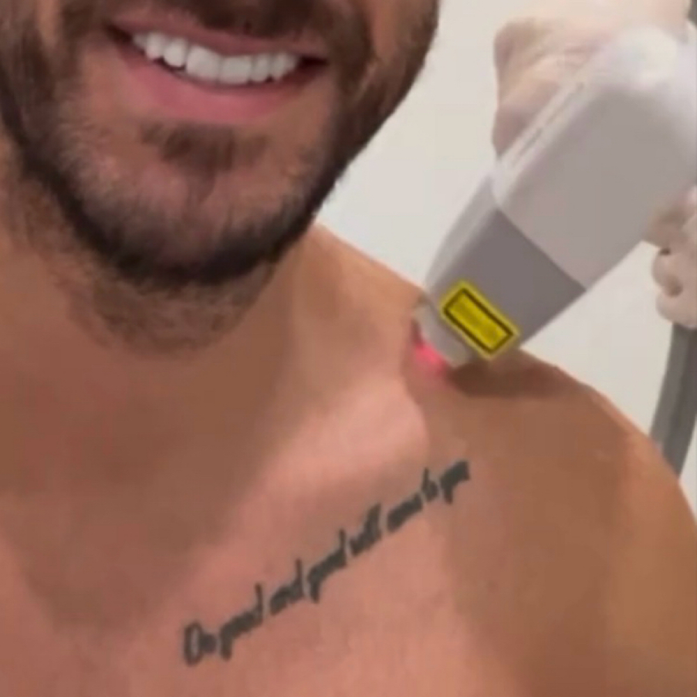 shoulders LASER HAIR REMOVAL at BEAUTY LAB COLLECTIVE in Miami, FL