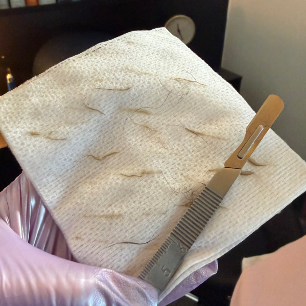 Dermaplane Facial at Ashlyn Rogers Esthetics in Paducah, KY