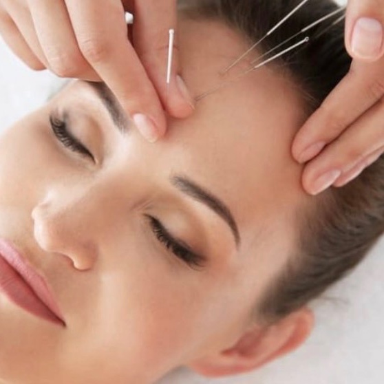 Acupuncture Services at Vital Lounge (Downtown Phoenix Wellness Hub) in Phoenix, AZ