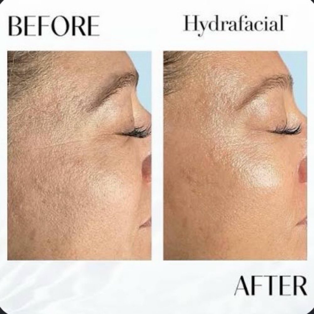 Hydrafacial at Desert Rain Skin in Scottsdale, AZ