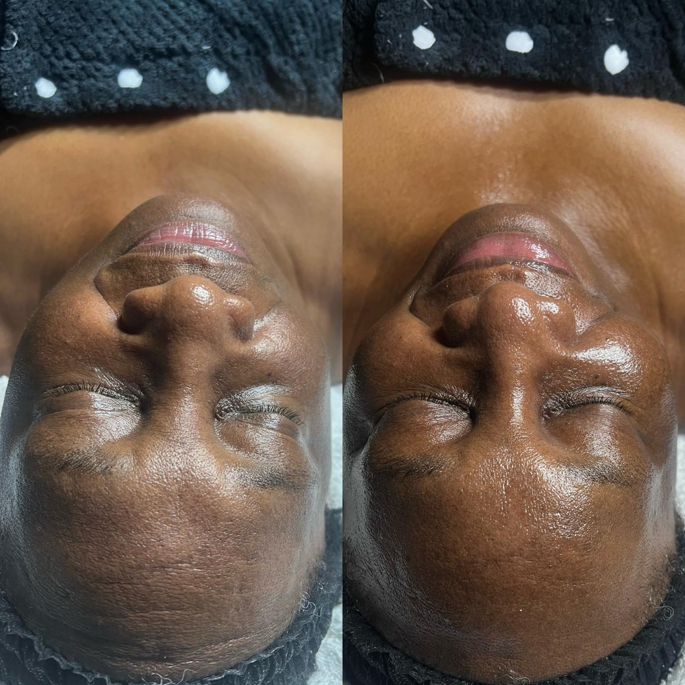 Notox Facial