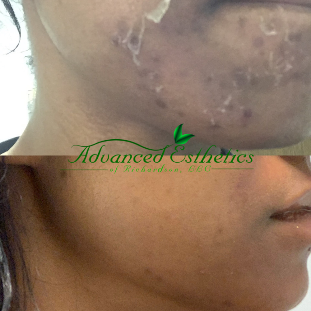 Chemical Peel Facial