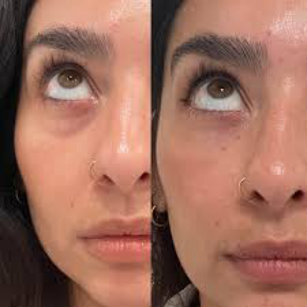 PRP Under Eye Treatment at All Aesthetics Kare in Upland, CA