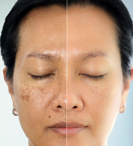 Medical Grade Chemical Peel