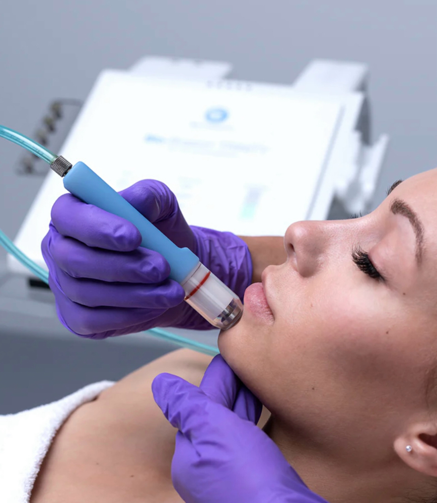 Deluxe  Diamond Microdermabrasion