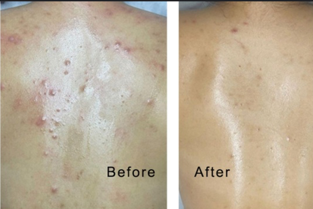 Acne Back Facial