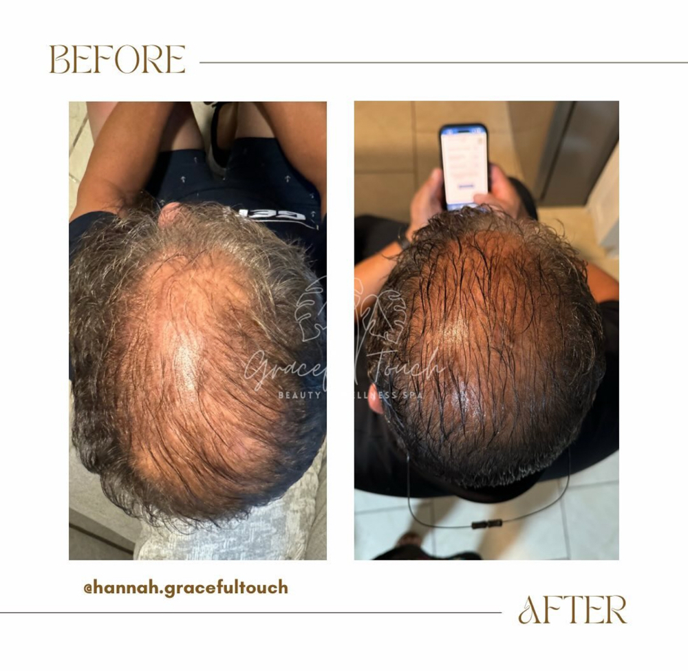 Scalp MesoHair