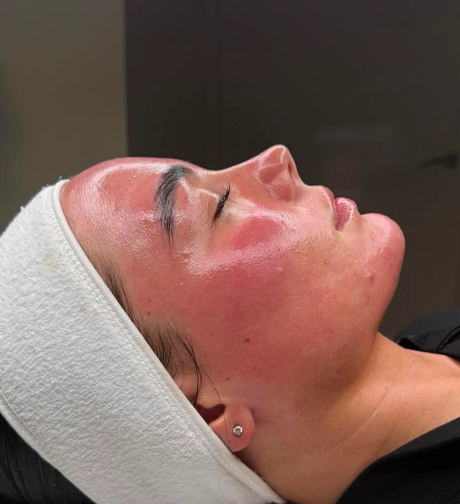 Traditional Microneedling Treatment