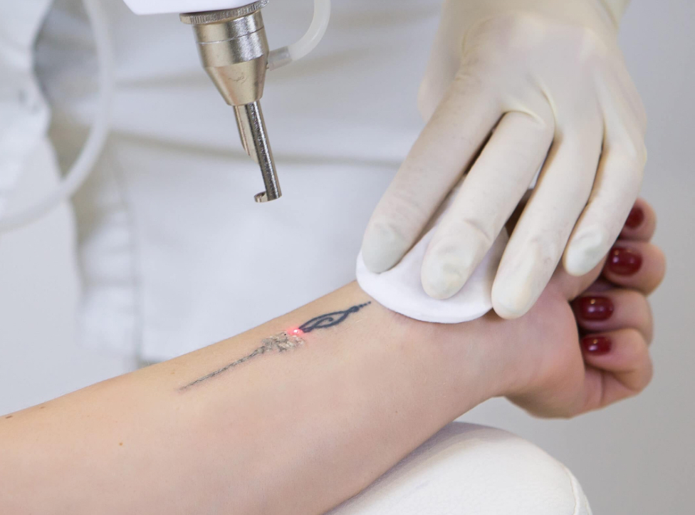 Corporal Tatoo Removal