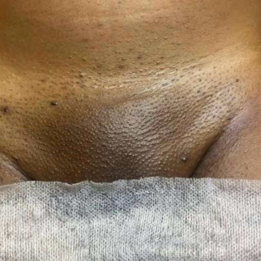 Brazilian Wax at Sincerely Pure Skincare in Atlanta, GA
