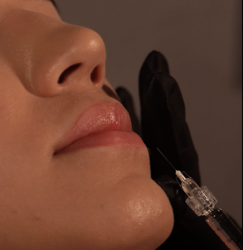 Lip Filler