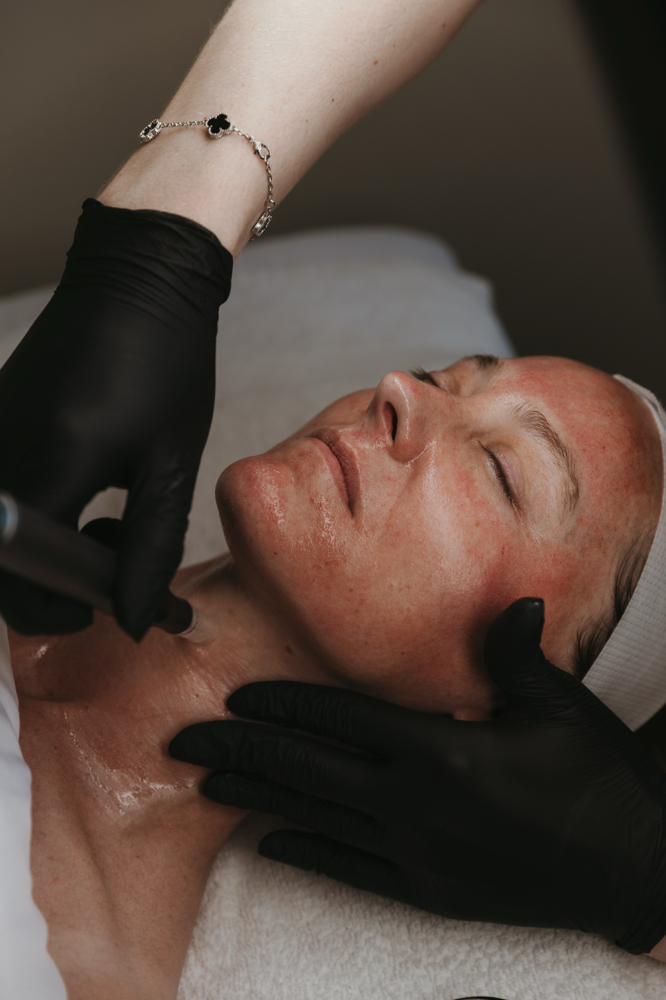 Ressurect Microneedling Facial