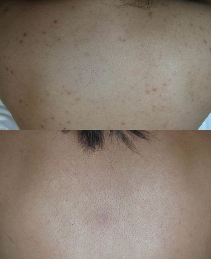 Back Chemical Peel