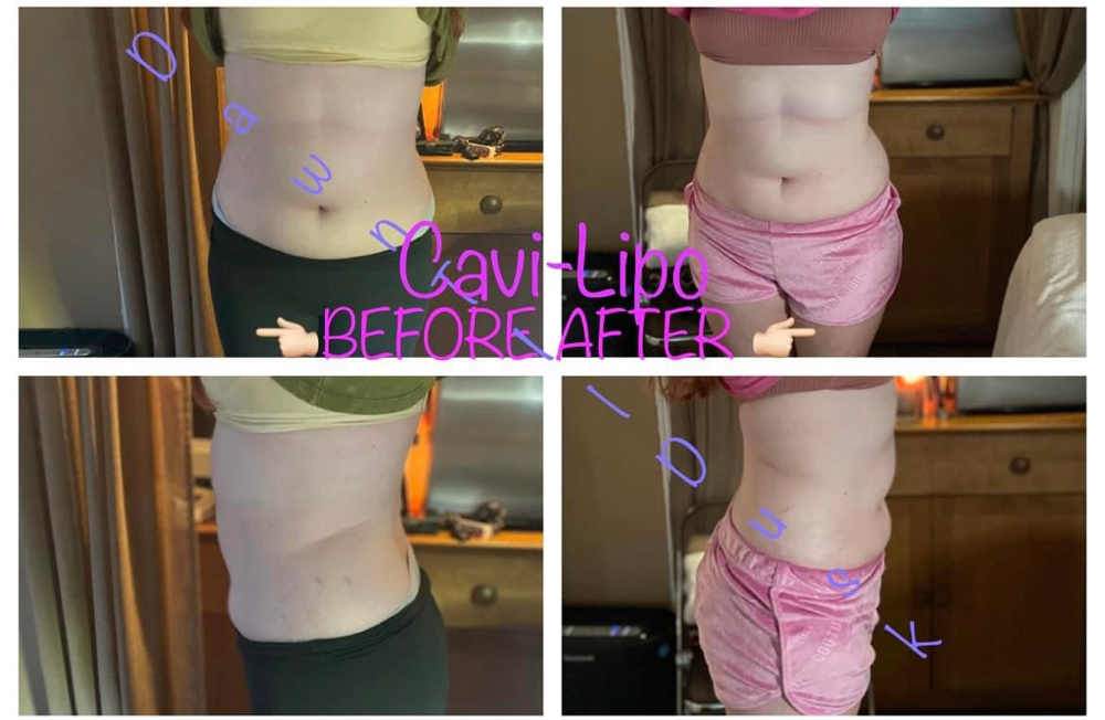 Cavi Lipo-