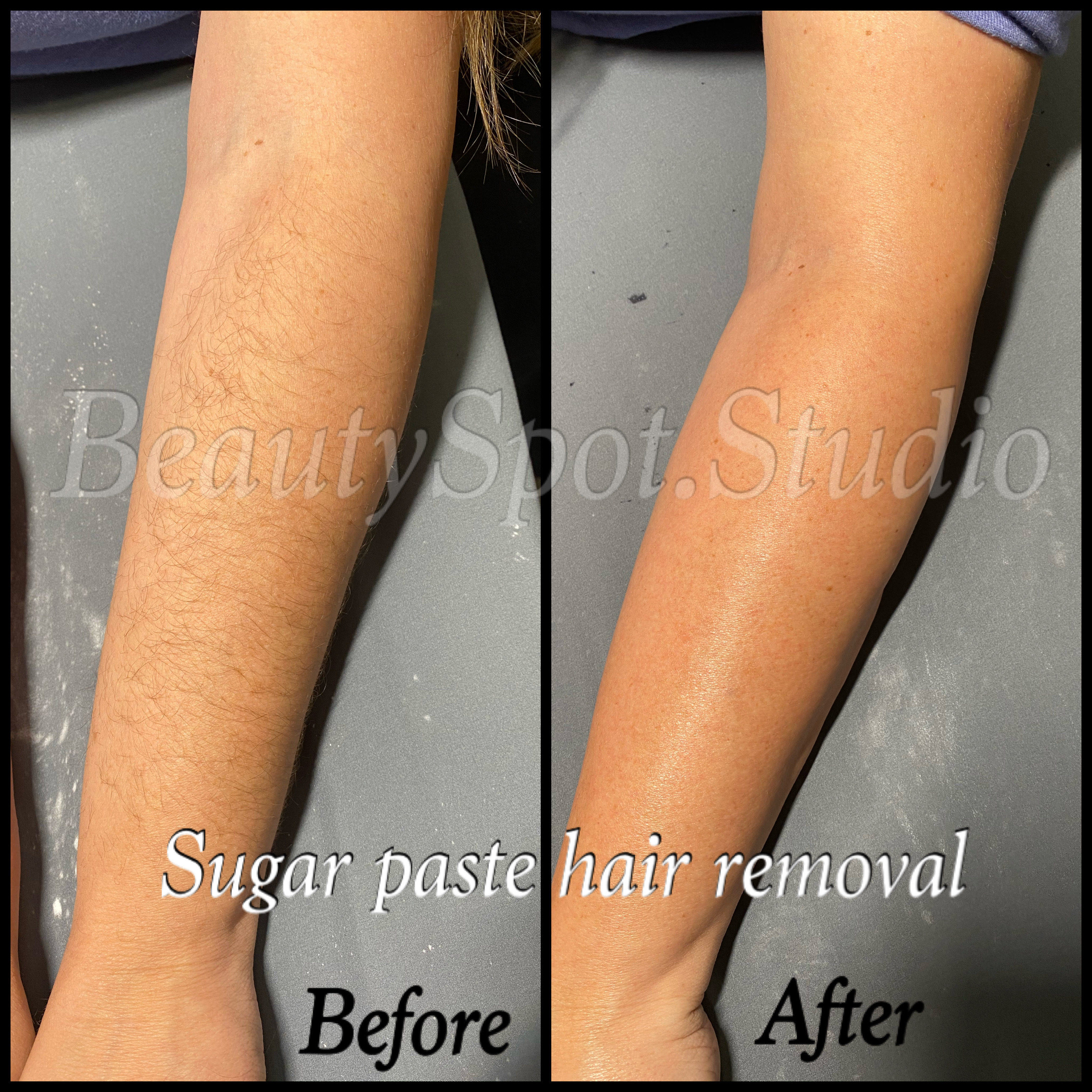 Half Arm Sugaring