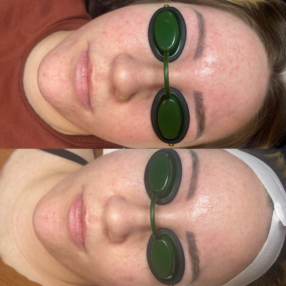 Acne Boot Camp