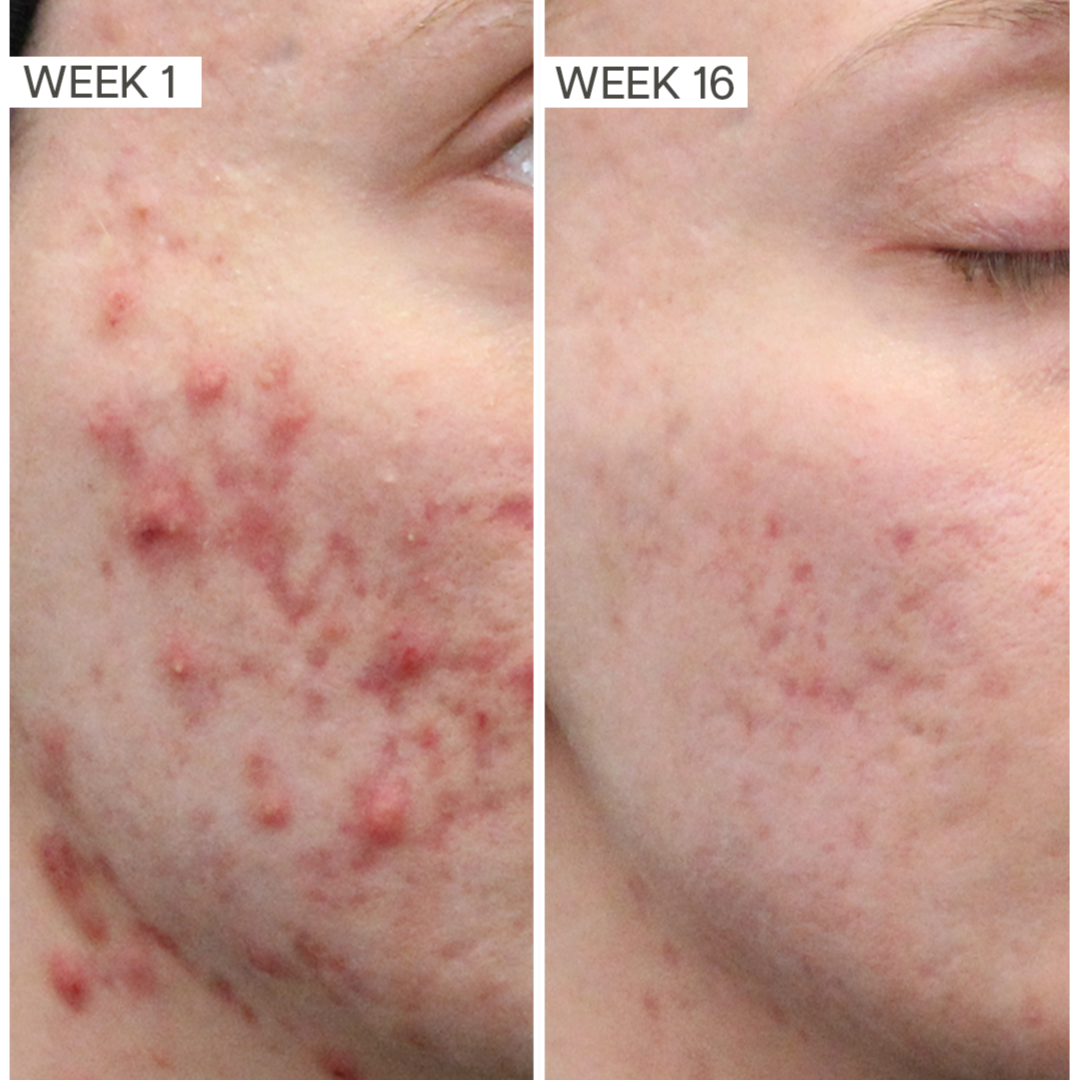 AcneBootcamp Consultation+Treatment at Bare Skin Esthetics in Roseville, CA