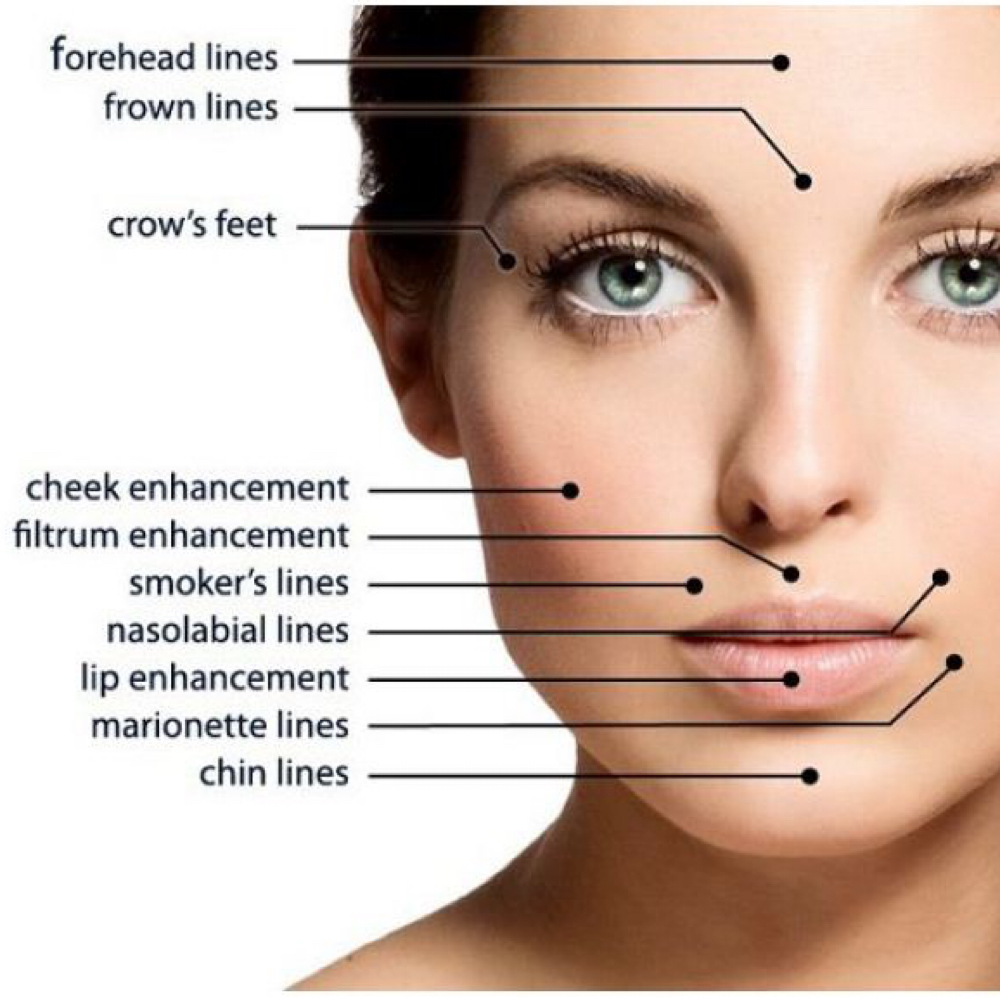 Dermal Filler at ALL HEART BEAUTY: Esthetics & Wellness in Advance, NC