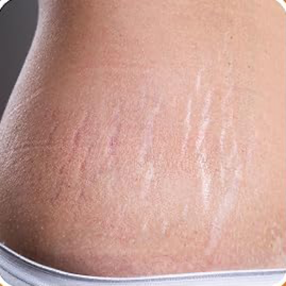 Microneedling Belly&Sides at ArteSana by Steph in Altamont, NY