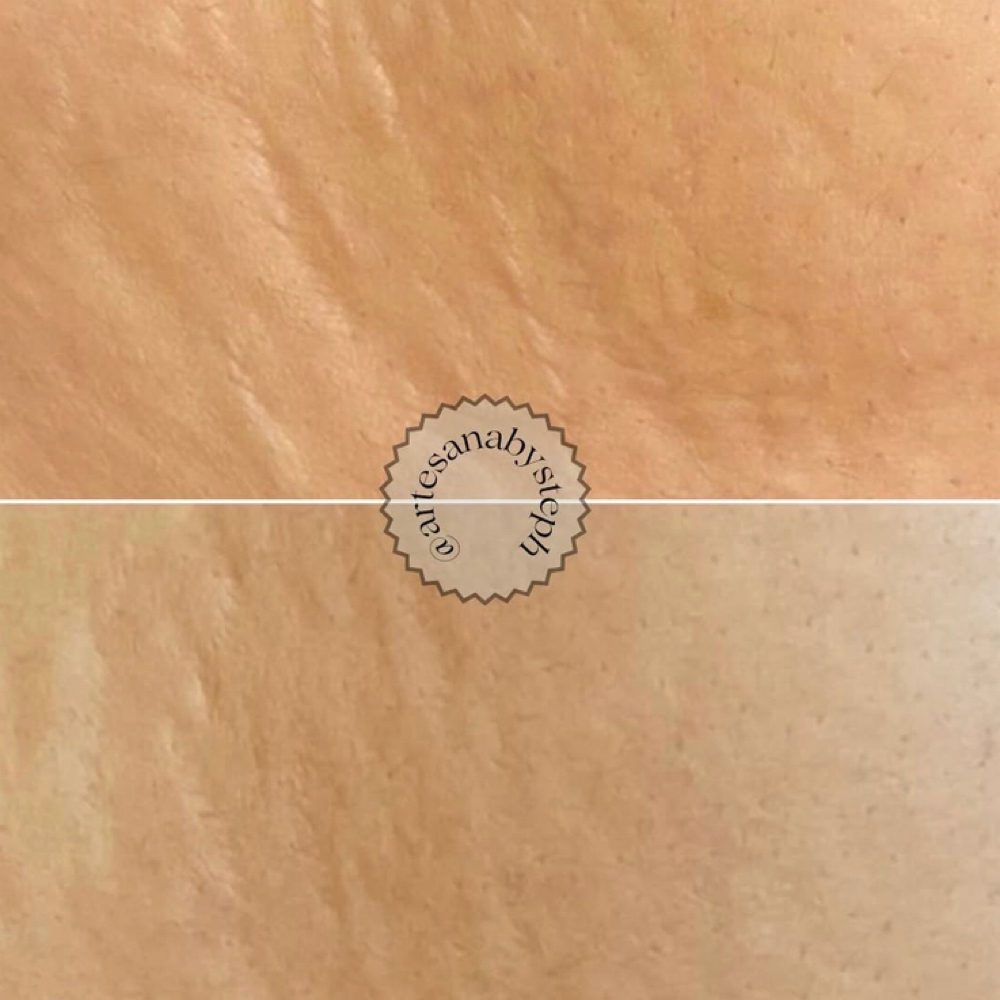 Microneedling Belly&Sides at ArteSana by Steph in Altamont, NY