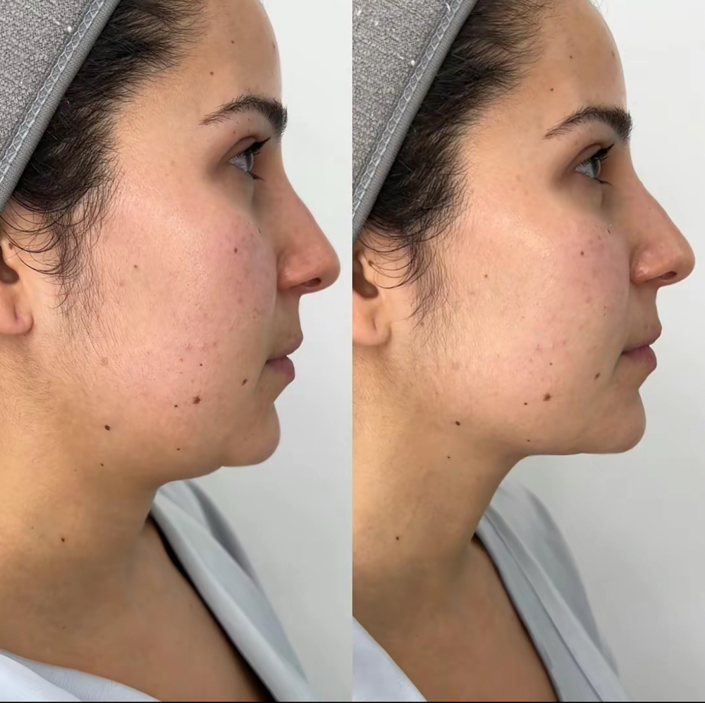 DOUBLE CHIN (DOBLE PAPADA)Endolaser at Natural Glow in Grand Praire, TX