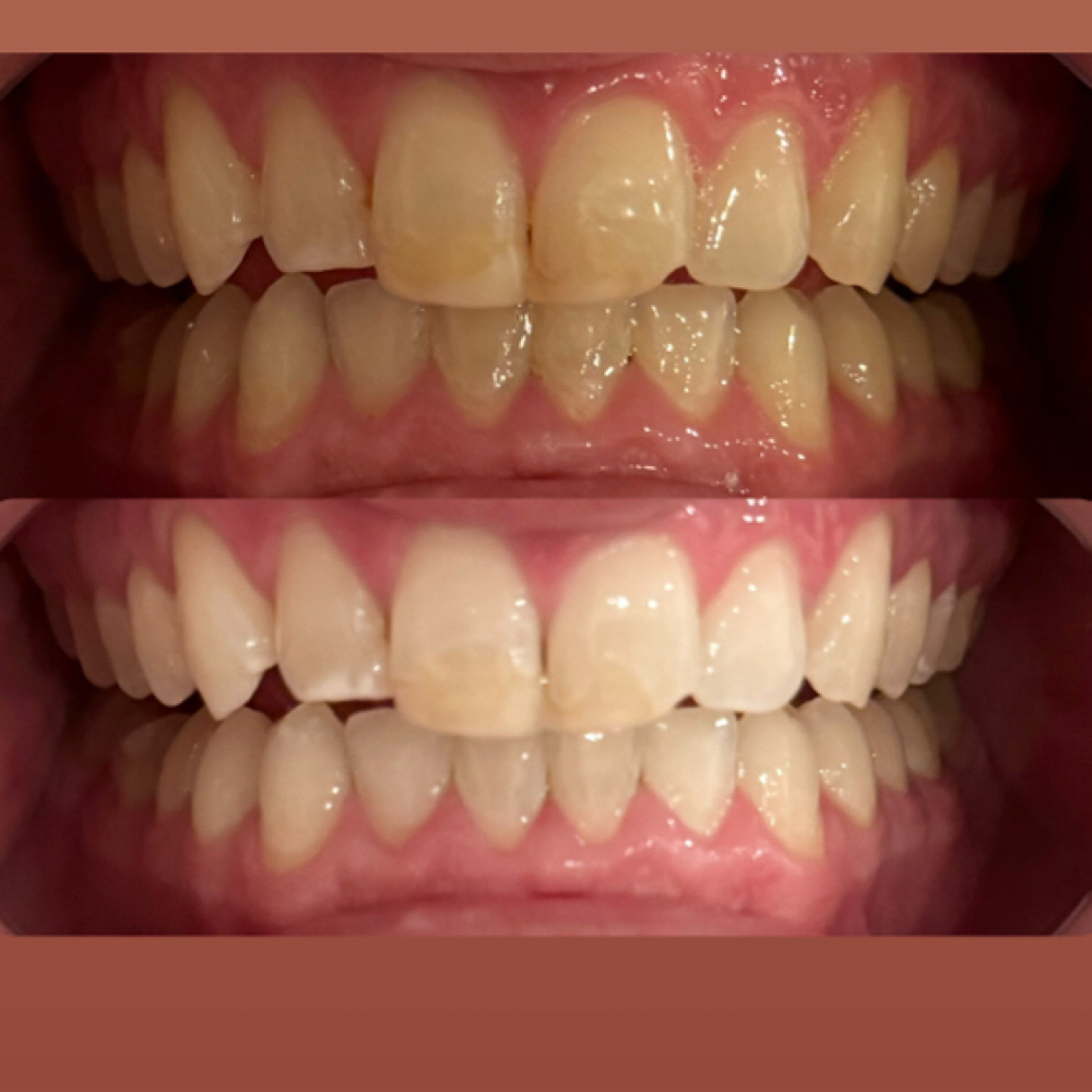 Teeth Whitening at Desert Gems in Reforge, UT