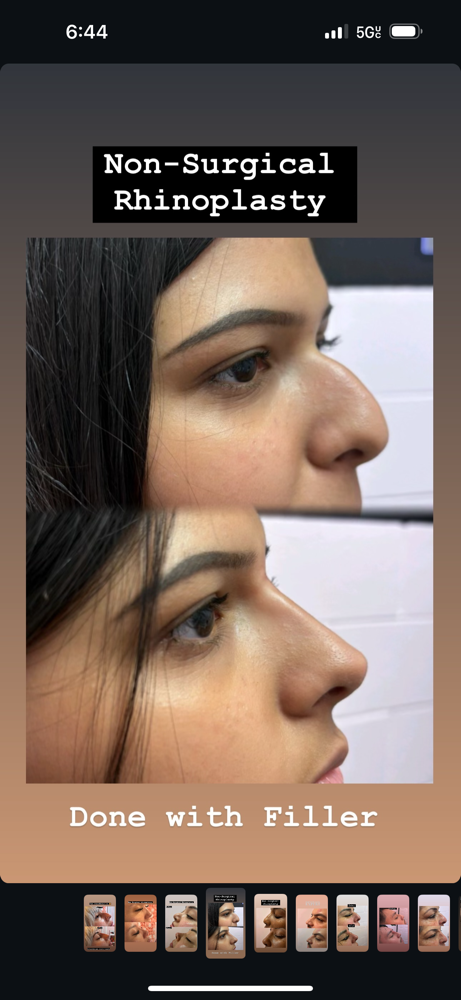 Liquid Rhinoplasty