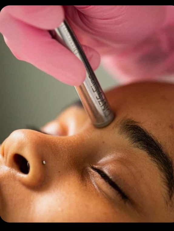 Microdermabrasion