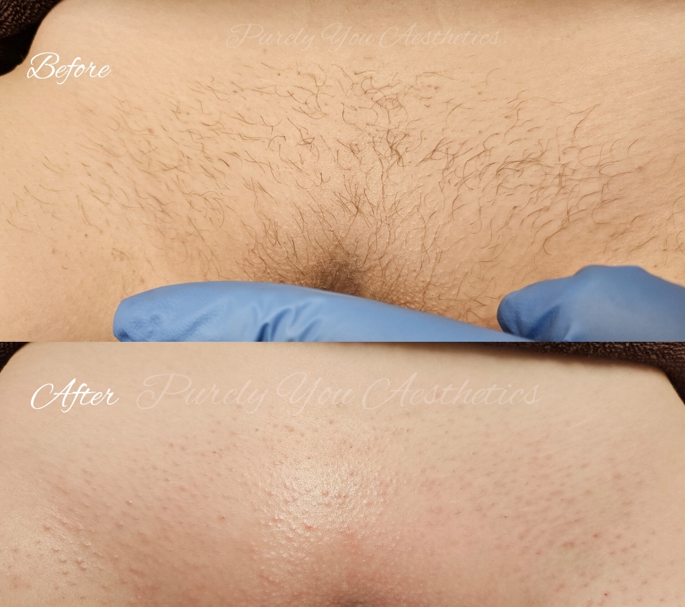 (V) Brazilian/Bikini Wax