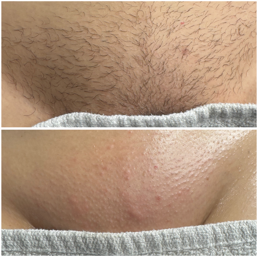 Brazilian Wax