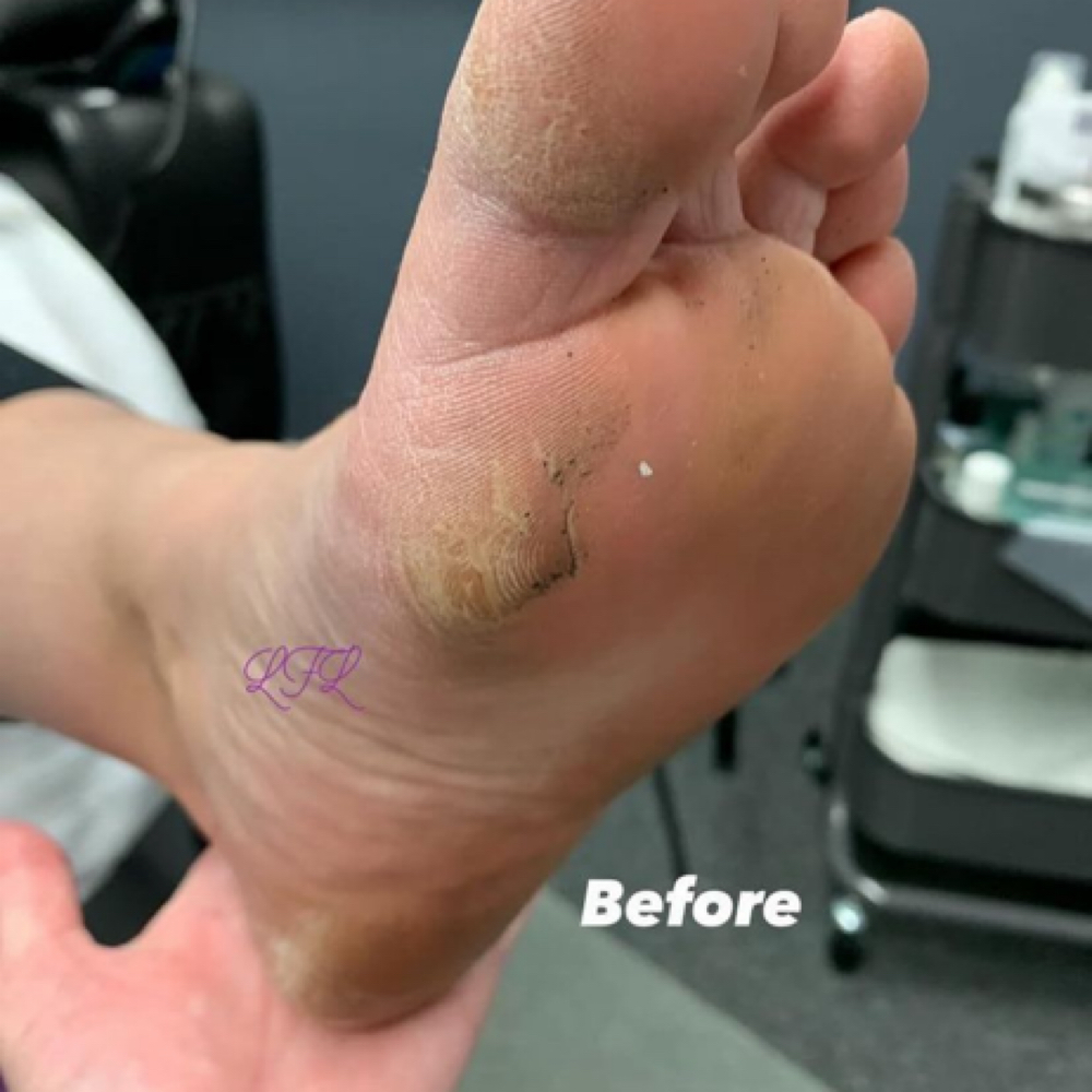 Callus Reduction at The Foot Fanatic in San Diego, CA