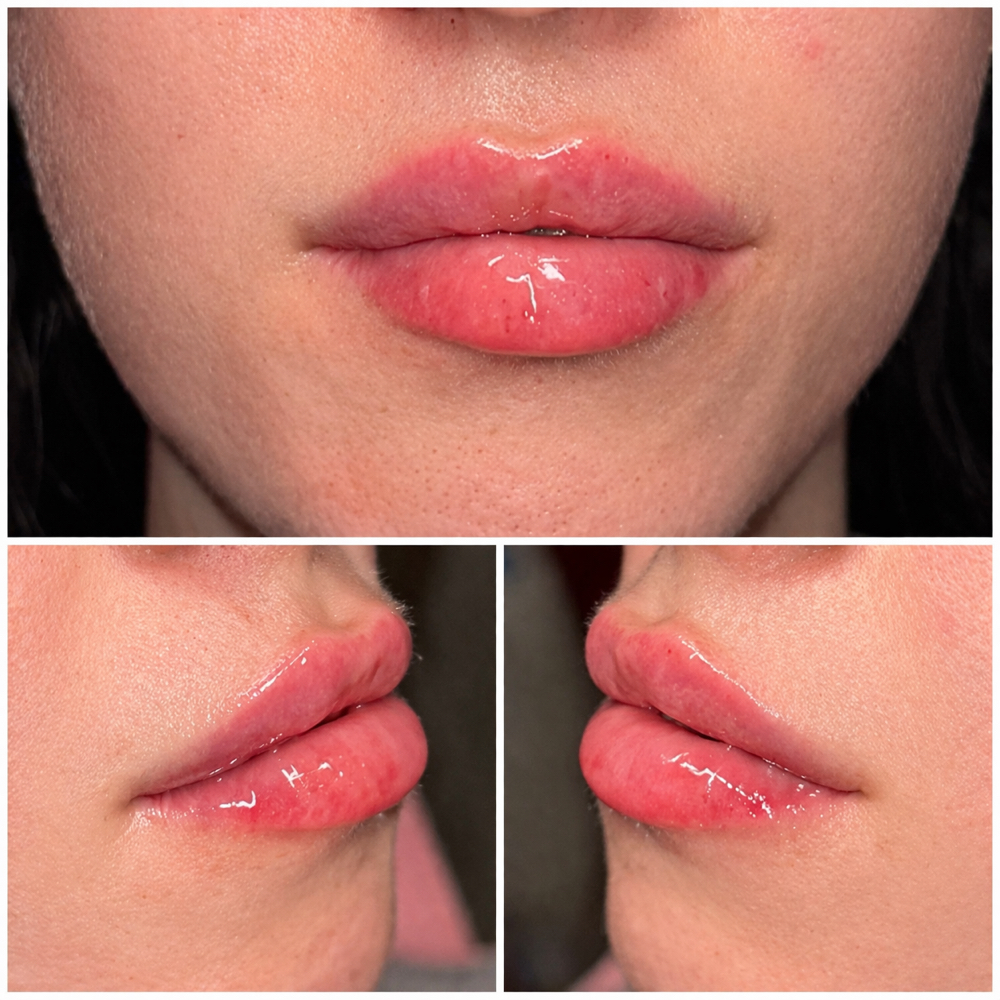 Half Syringe Dermal Filler at Alt Boutique & Aesthetics | Nurse Injector in Hereford, TX