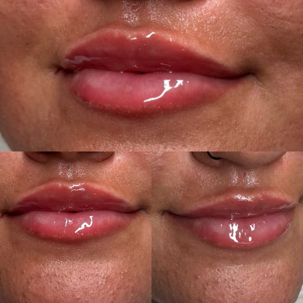 Half Syringe Dermal Filler at Alt Boutique & Aesthetics | Nurse Injector in Hereford, TX
