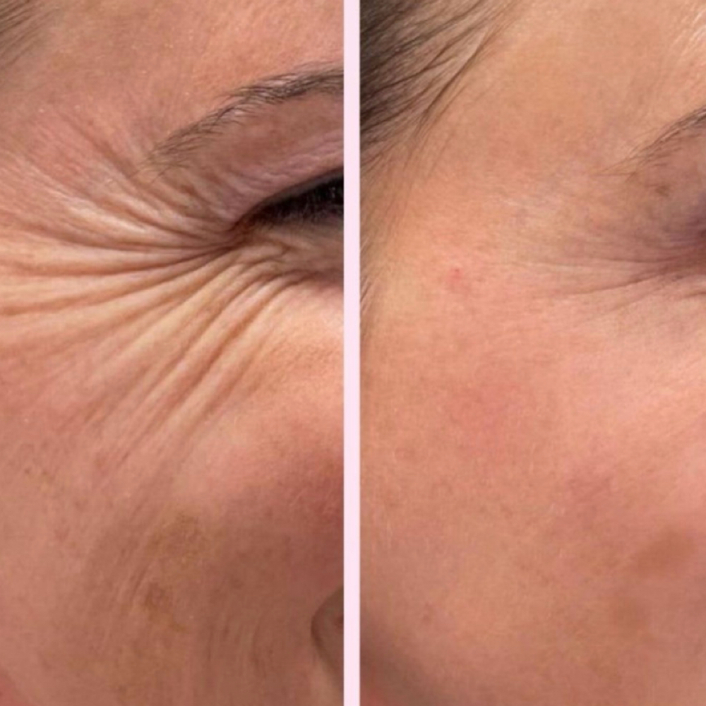 Crows Feet at Lc Beauty Vault in Sinton, TX