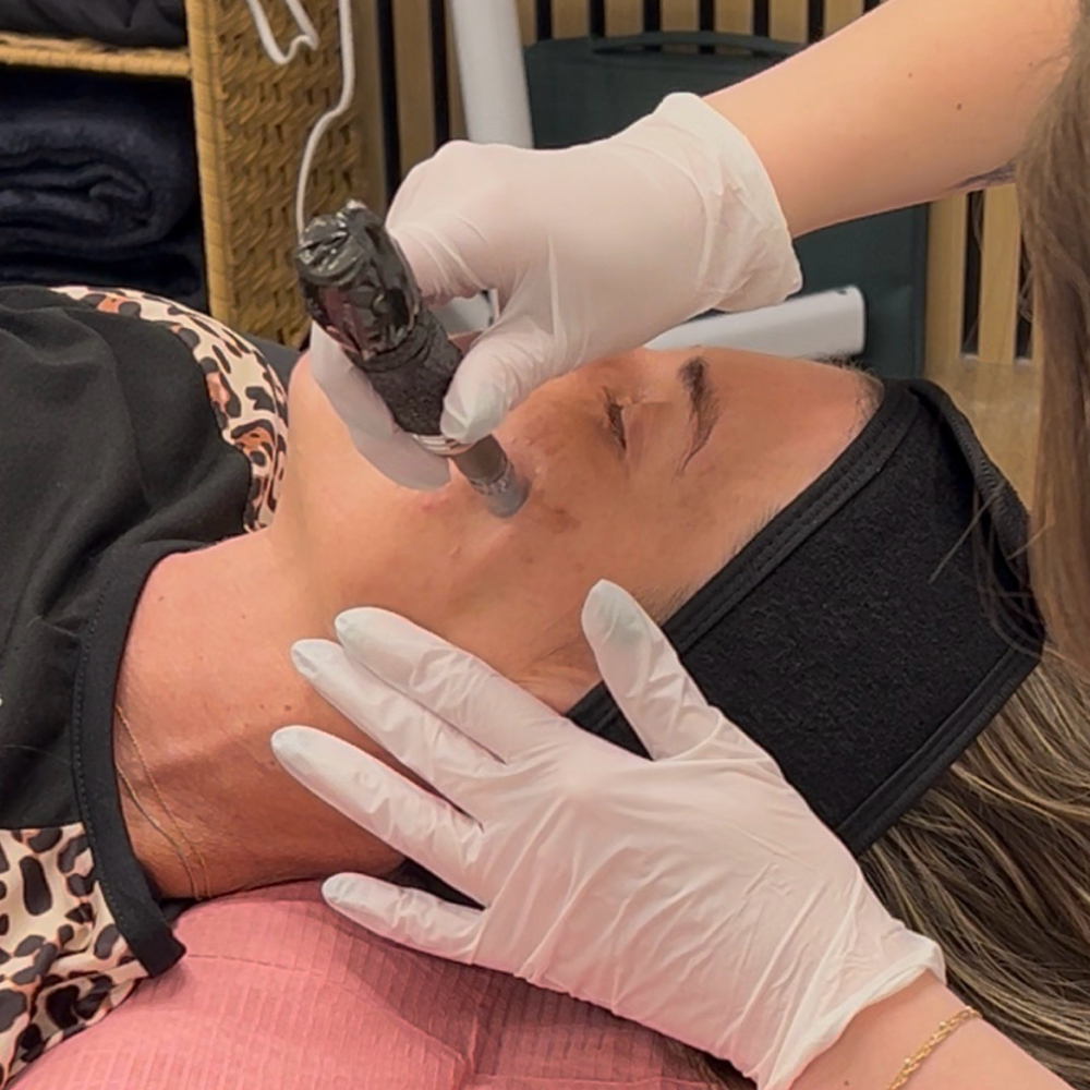 Microneedling at Lotus Moon Esthetics in Mesa, AZ