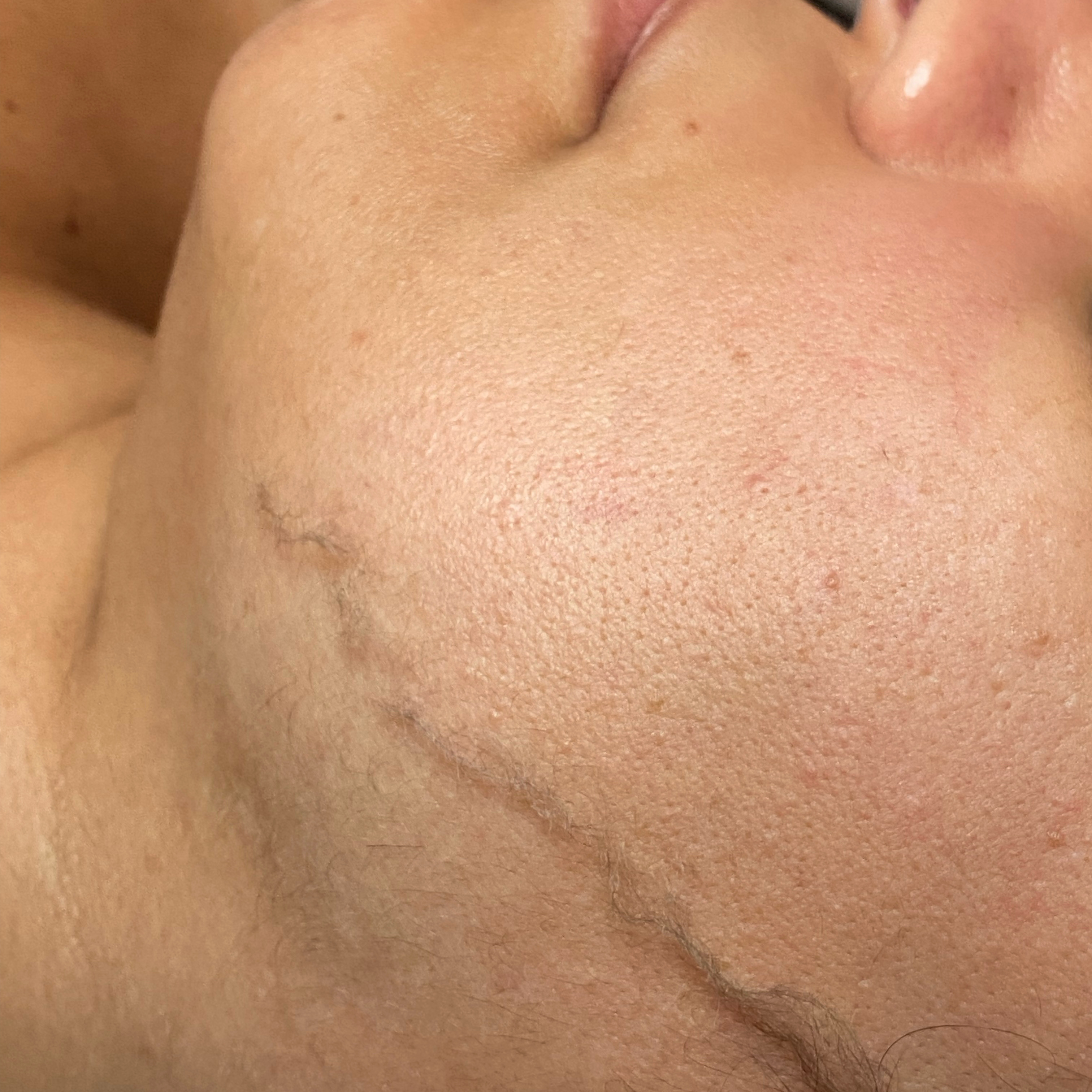 Add-on Dermaplaning at Skin & Beauty Aesthetics Studio in New York, NY
