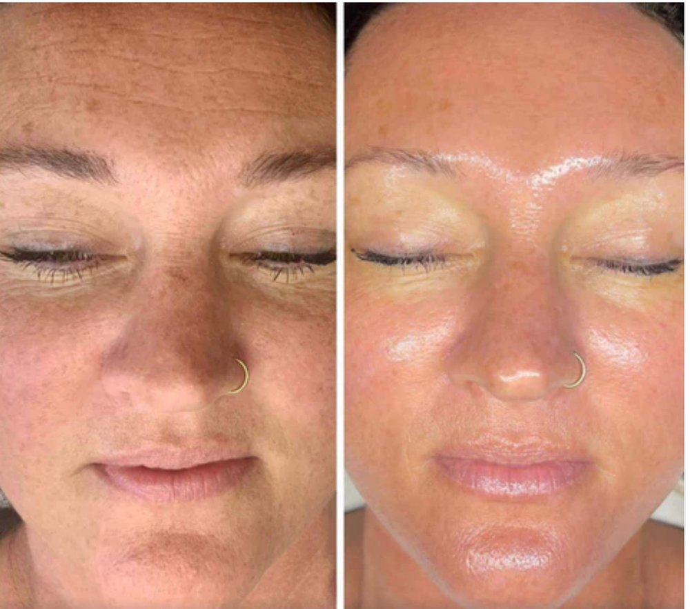 HydroDiamond Glow Facial at Loba Beauty Spa in Paterson, NJ