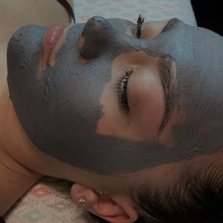 Acne Facial