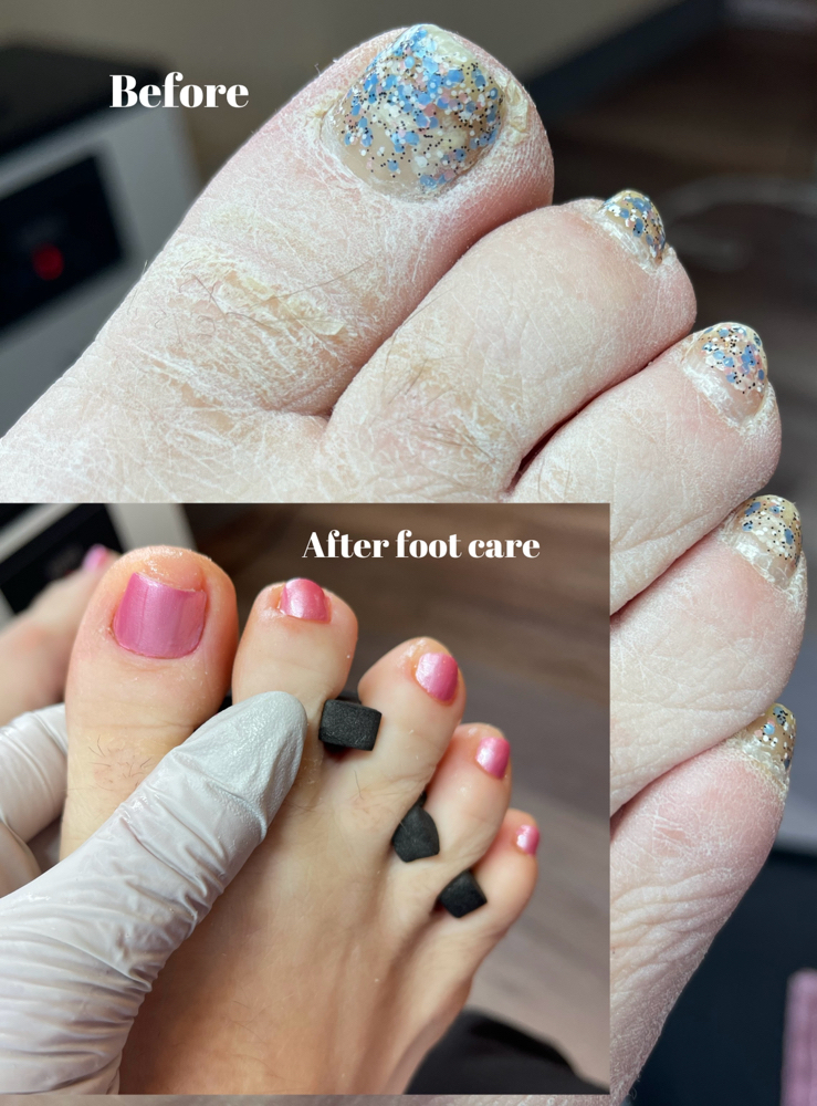 Initial Foot care