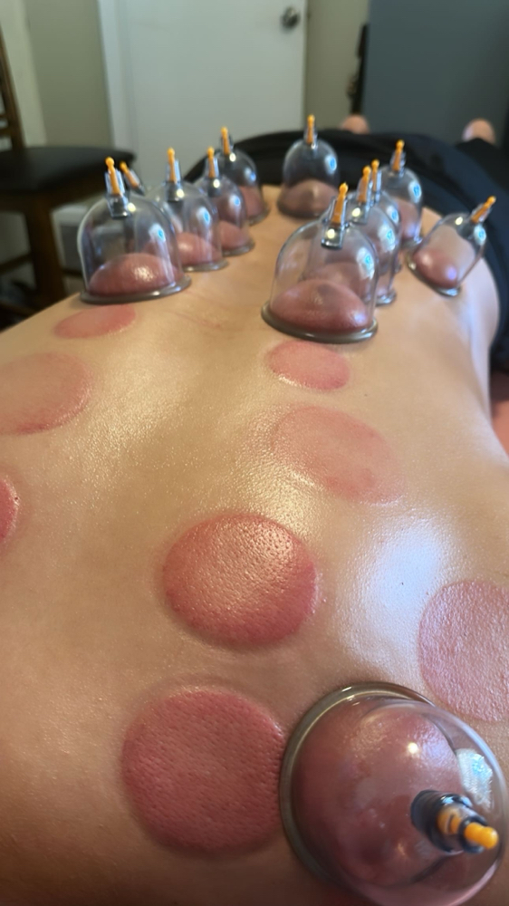 Cupping Therapy