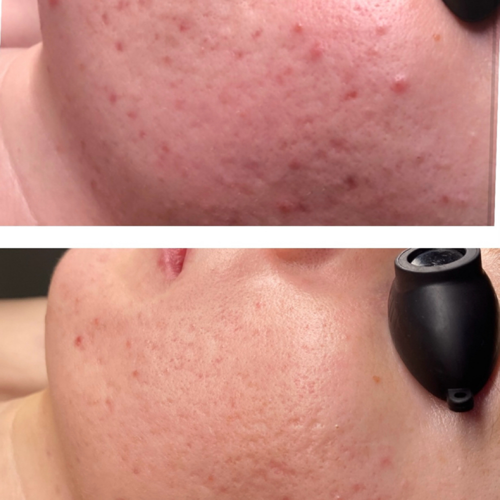 Acne Assessment at MOON Organics & Esthetics in Decatur, GA