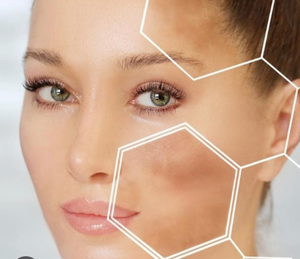 MELASMA TREATMENT