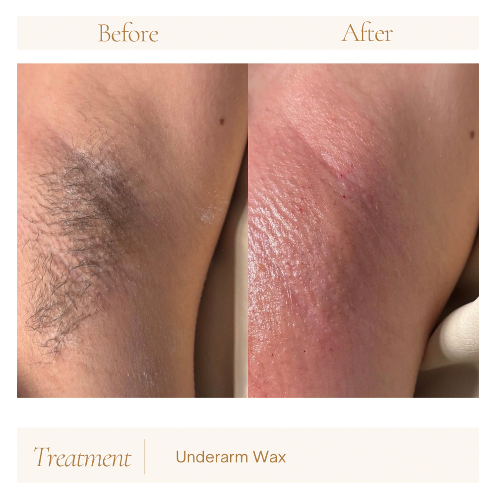 Underarms at Good Esthetics in Los Lunas, NM