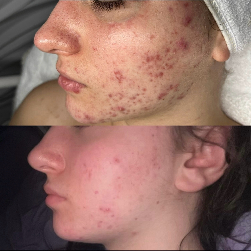Custom Acne facial + Peel at Glow by Jess in Troy, MI