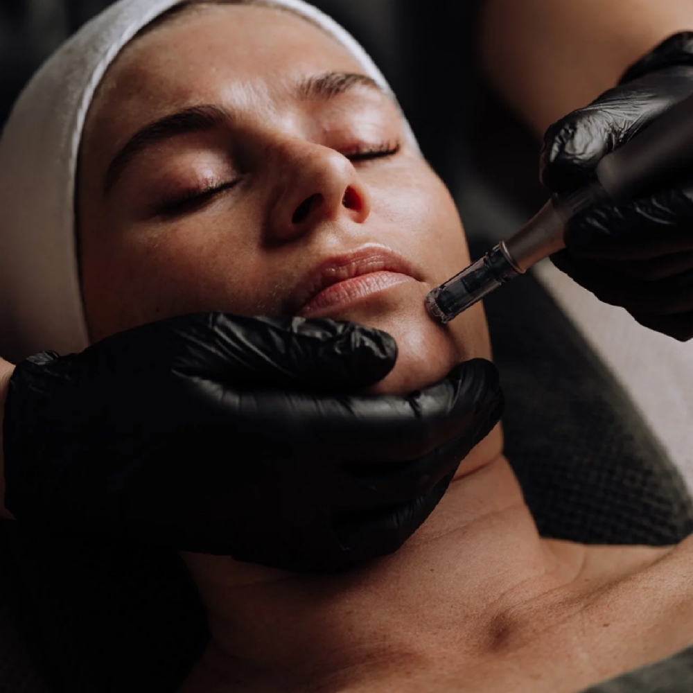 Mico-Channeling With Antioxidants at Skinrevivalco in San Diego, CA