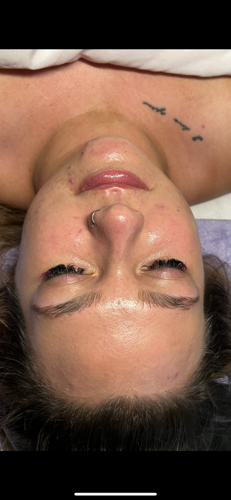 Anti Acne Facial at Eyeconic Beauty in Johnstown, CO