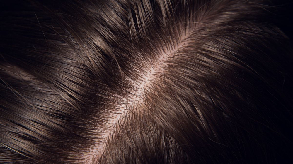 Scalp Analysis And Treatment