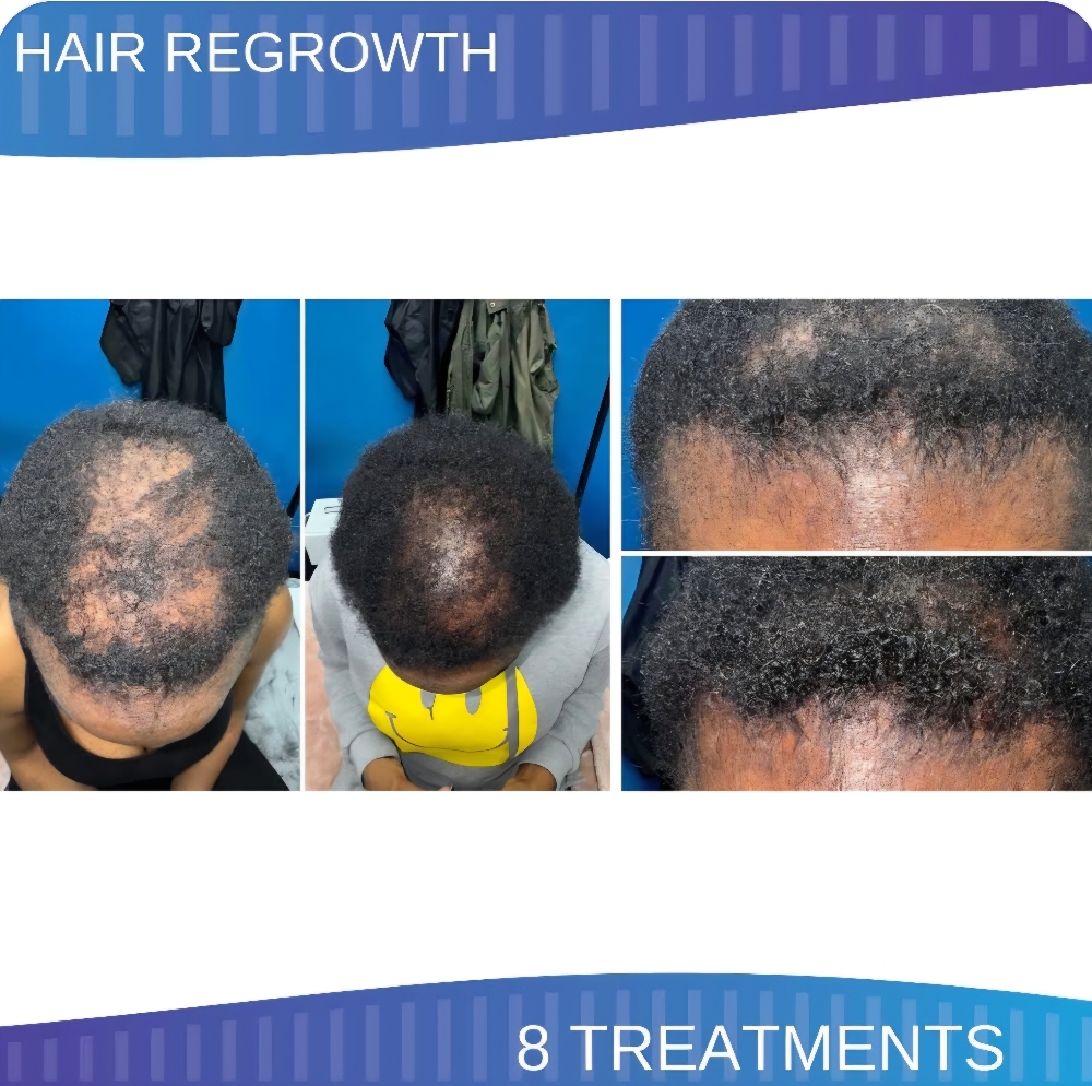 Hair Regeneration With Procell